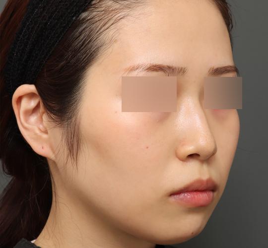 20代女性のバッカルファット除去 Before 症例写真