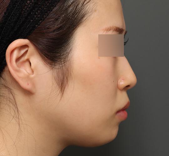 20代女性のバッカルファット除去 Before 症例写真