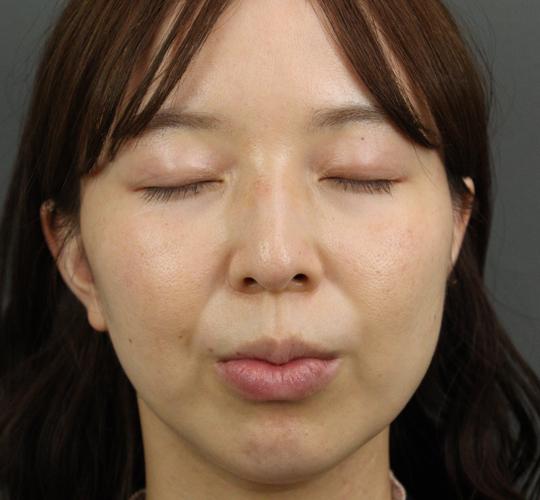 30代女性のボトックス(小顔) Before 症例写真
