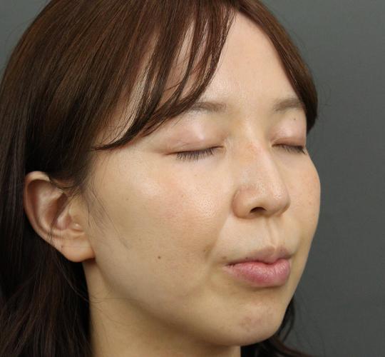 30代女性のハイブリッドリフト Before 症例写真