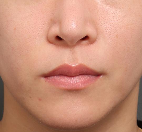 30代女性のリジュランスキンボトックス After 症例写真