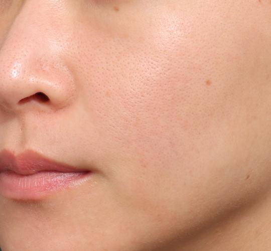 30代女性のリジュランスキンボトックス After 症例写真