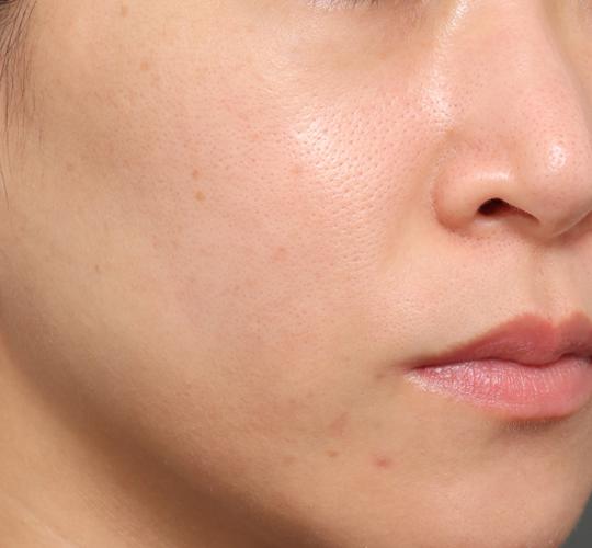 30代女性のリジュランスキンボトックス After 症例写真