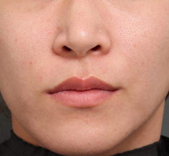 30代女性のリジュランスキンボトックス Before 症例写真