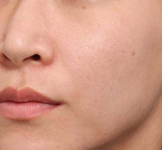 30代女性のリジュランスキンボトックス Before 症例写真