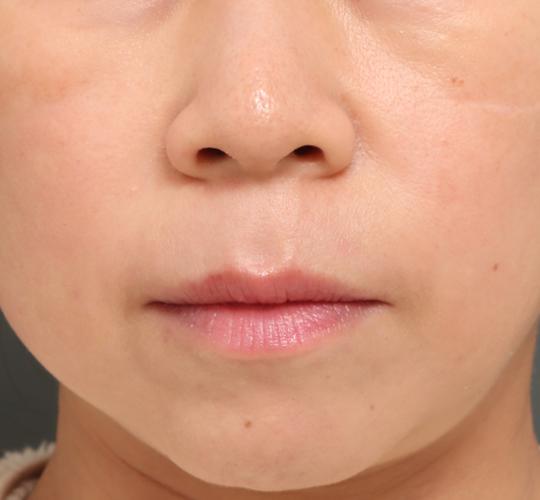 40代女性のリジュランスキンボトックス After 症例写真
