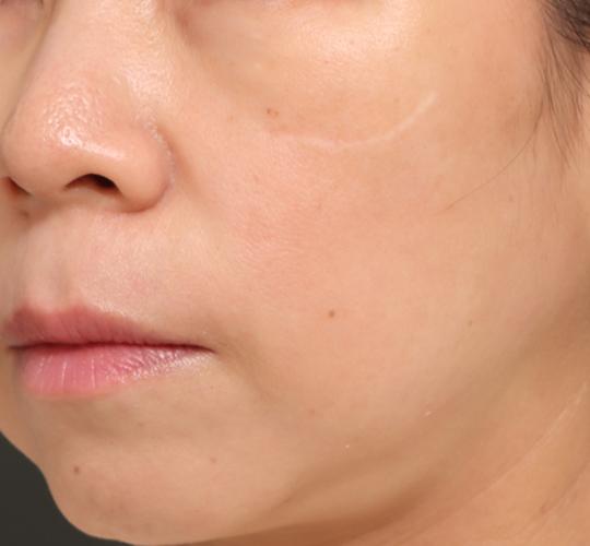 40代女性のリジュランスキンボトックス After 症例写真