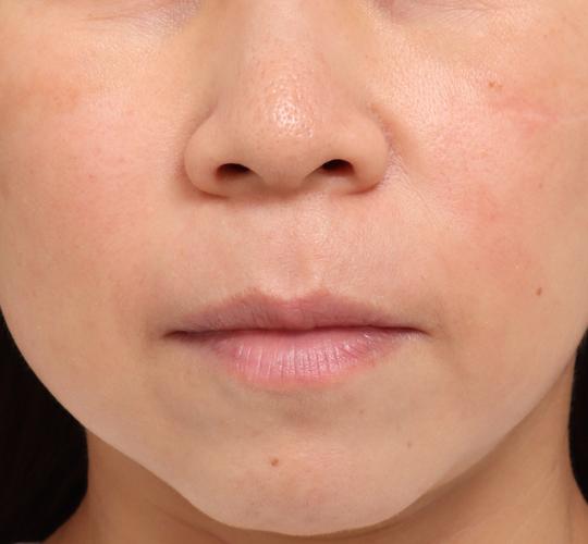 40代女性のリジュランスキンボトックス Before 症例写真