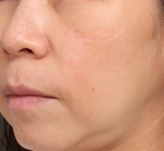 40代女性のリジュランスキンボトックス Before 症例写真