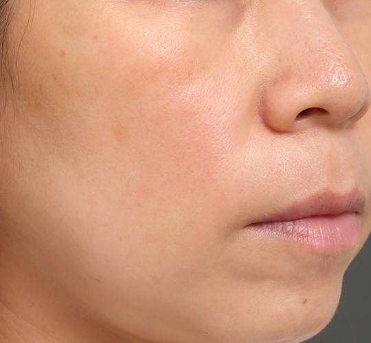 40代女性のリジュランスキンボトックス Before 症例写真