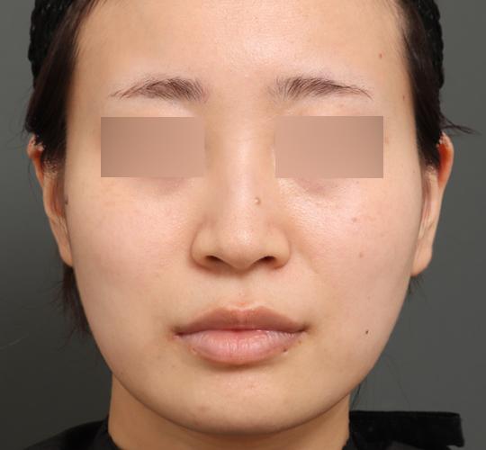 20代女性のボトックス(小顔) After 症例写真