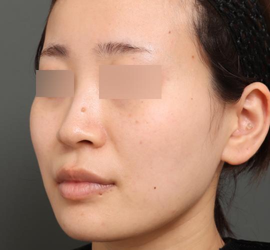 20代女性のバッカルファット除去 After 症例写真