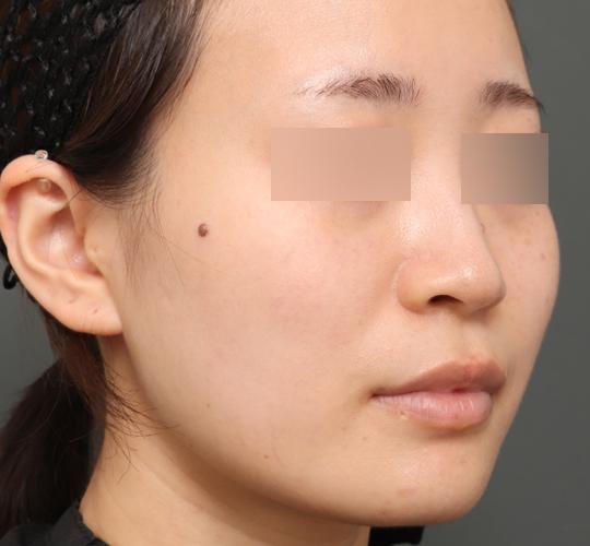 20代女性のバッカルファット除去 After 症例写真