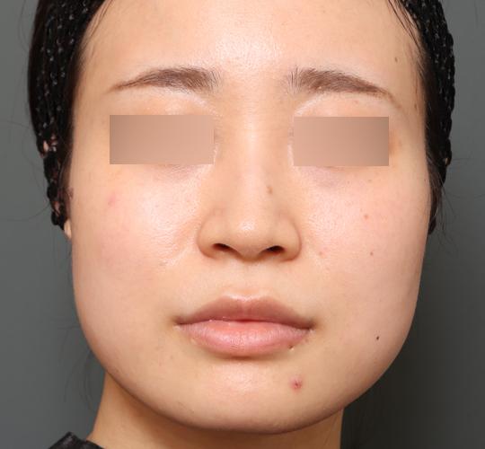 20代女性のボトックス(小顔) Before 症例写真
