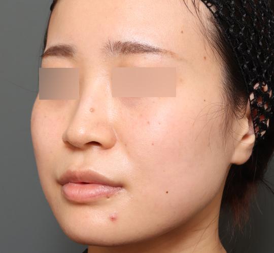 20代女性のバッカルファット除去 Before 症例写真