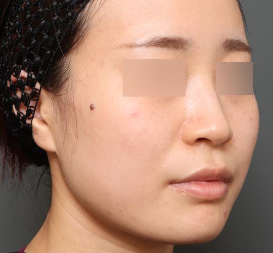 20代女性のバッカルファット除去 Before 症例写真