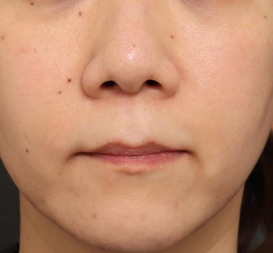 30代女性のリジュランスキンボトックス After 症例写真