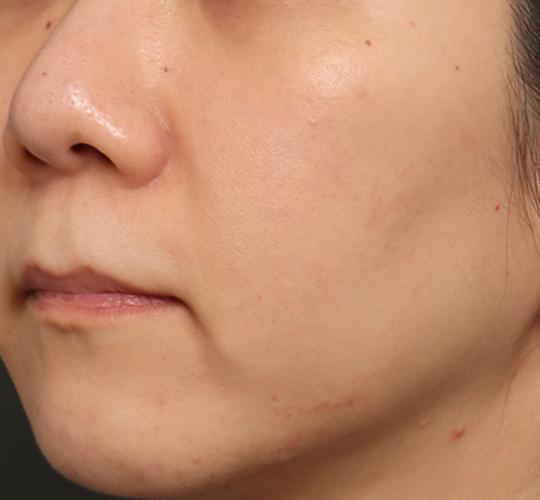 30代女性のリジュランスキンボトックス After 症例写真
