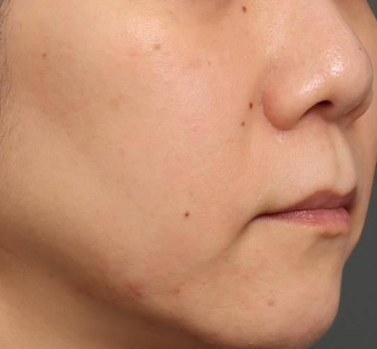 30代女性のリジュランスキンボトックス After 症例写真