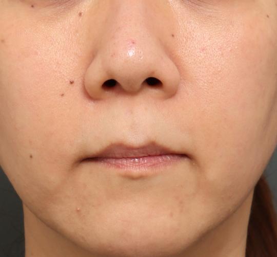 30代女性のリジュランスキンボトックス Before 症例写真