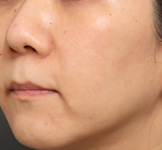 30代女性のリジュランスキンボトックス Before 症例写真