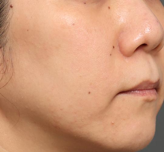 30代女性のリジュランスキンボトックス Before 症例写真
