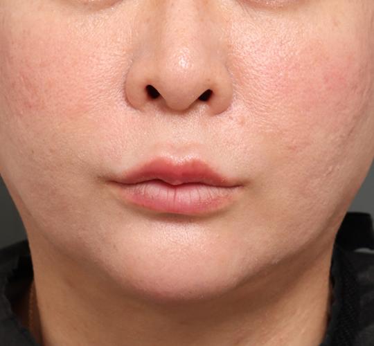 40代女性の人中短縮フォトナ After 症例写真