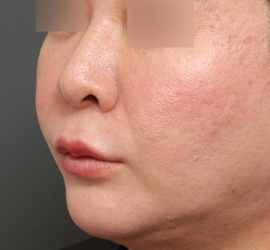 40代女性の唇・口元の整形 After 症例写真