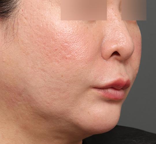 40代女性の人中短縮フォトナ After 症例写真