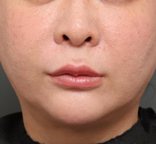 40代女性の人中短縮フォトナ Before 症例写真