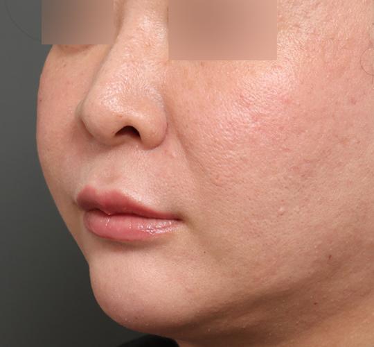 40代女性の唇・口元の整形 Before 症例写真