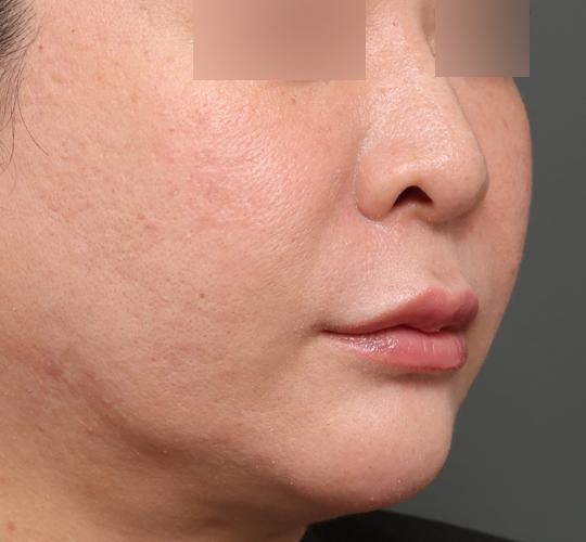 40代女性の人中短縮フォトナ Before 症例写真