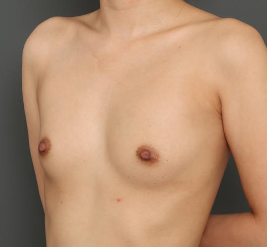 20代女性の豊胸バッグMotiva(モティバ) エルゴノミックス Before 症例写真