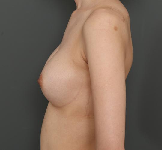 20代女性の豊胸バッグナトレル After 症例写真