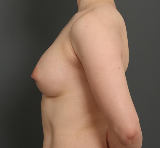 30代女性の豊胸バッグナトレル After 症例写真