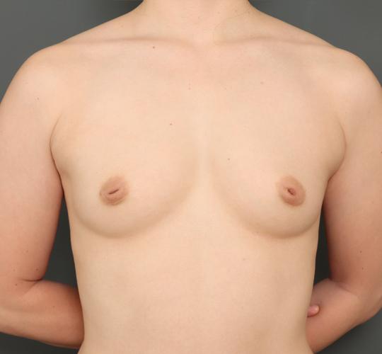 30代女性の豊胸バッグナトレル Before 症例写真