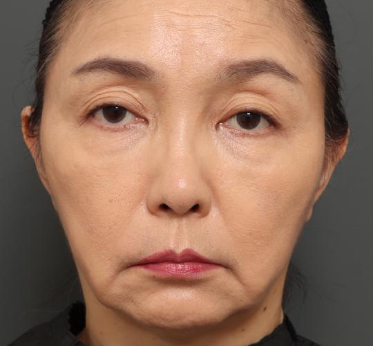 50代女性のエラ・アゴ・小顔 After 症例写真