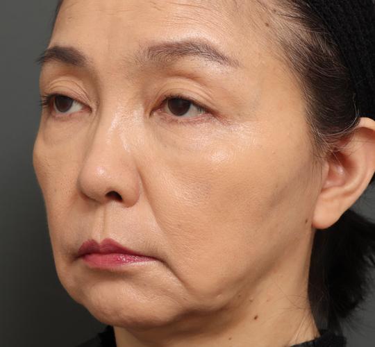 50代女性のチークリフト・フェイスリフト After 症例写真