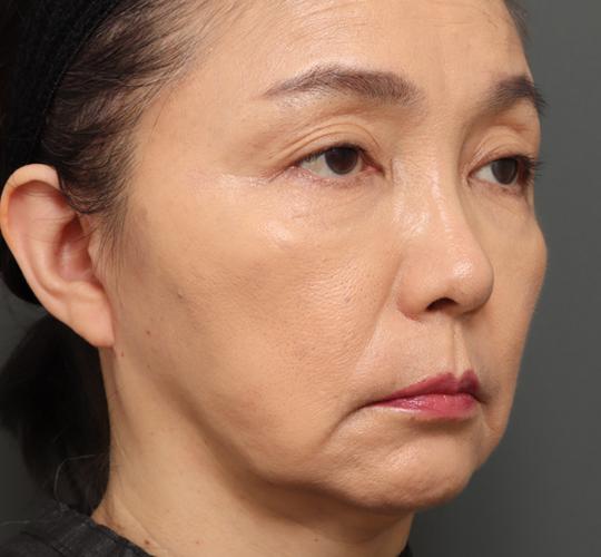 50代女性のチークリフト・フェイスリフト After 症例写真