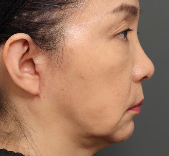 50代女性のチークリフト・フェイスリフト After 症例写真