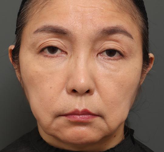50代女性のエラ・アゴ・小顔 Before 症例写真