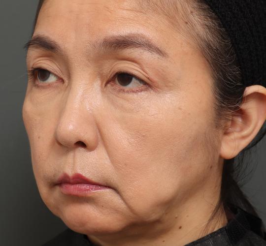 50代女性のチークリフト・フェイスリフト Before 症例写真