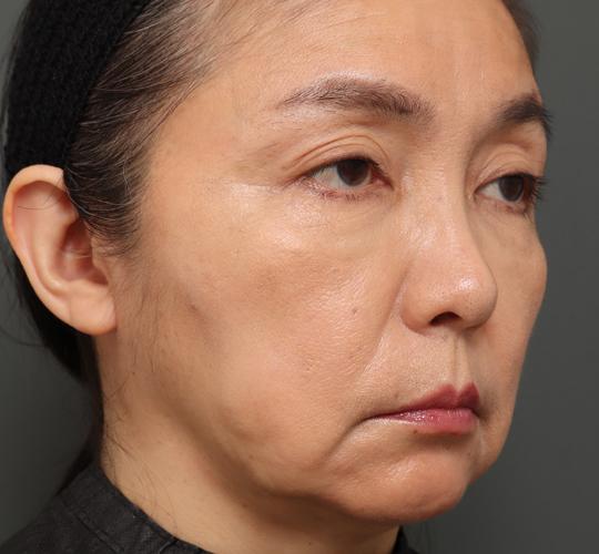 50代女性のチークリフト・フェイスリフト Before 症例写真