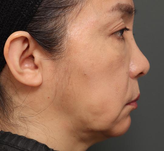 50代女性のチークリフト・フェイスリフト Before 症例写真