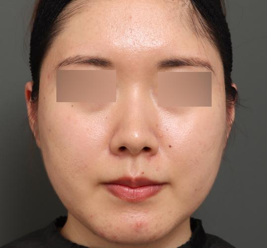 20代女性のバッカルファット除去 After 症例写真