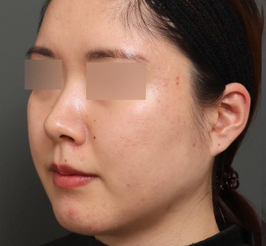 20代女性の顔の脂肪吸引 After 症例写真