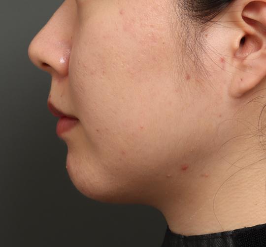 20代女性のバッカルファット除去 After 症例写真