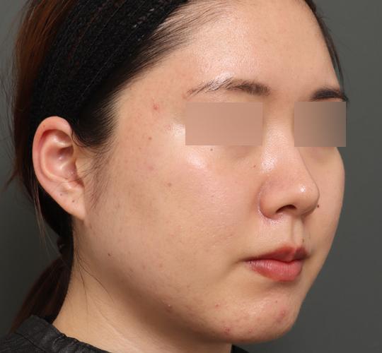 20代女性のバッカルファット除去 After 症例写真