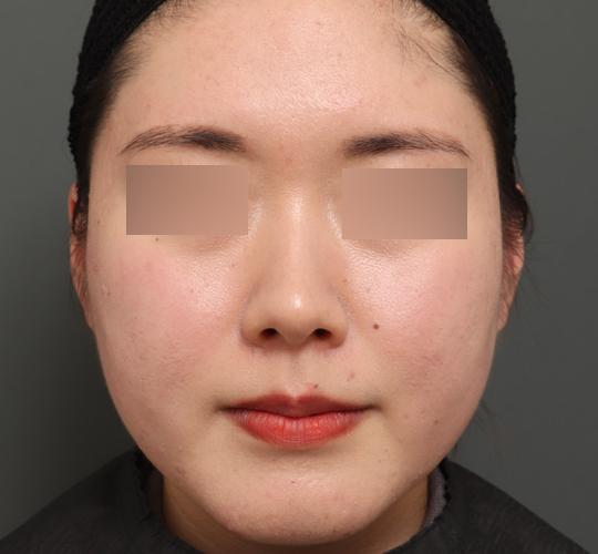 20代女性のバッカルファット除去 Before 症例写真