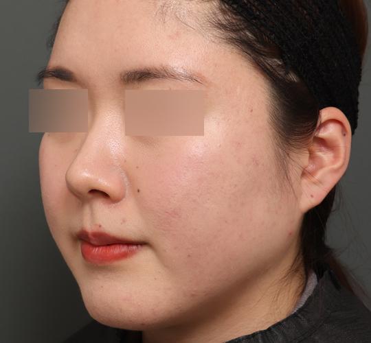 20代女性の顔の脂肪吸引 Before 症例写真